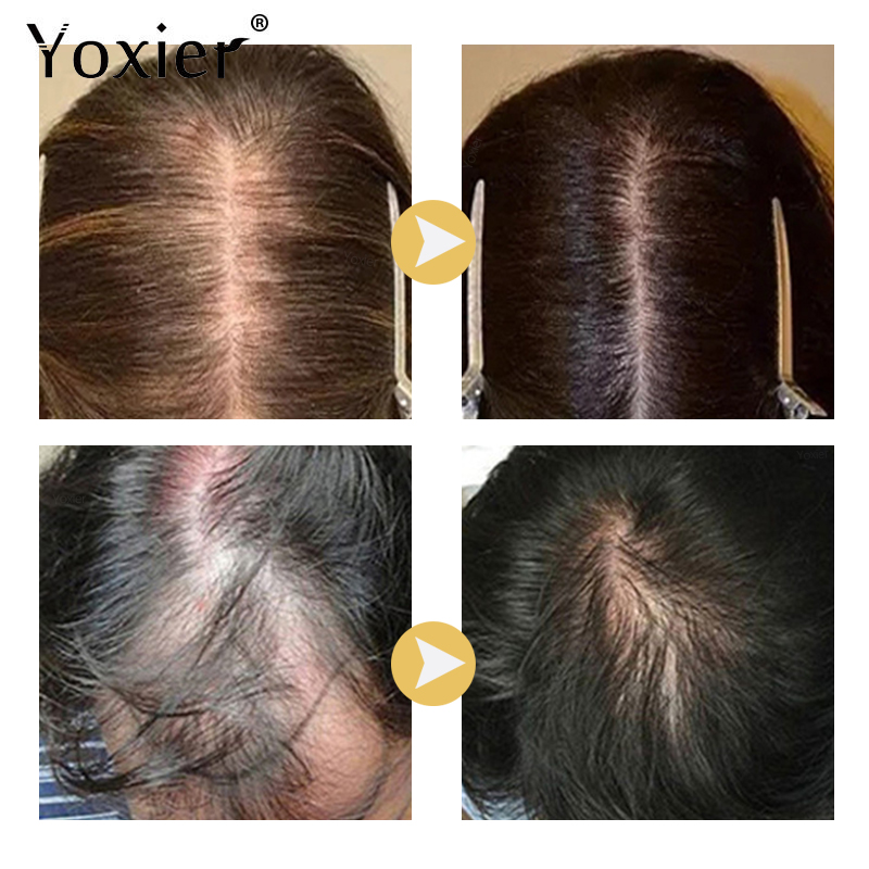 인텐시브 성장 세럼 탈모 방지 스프레이 두피 트리트먼트 - Hair Care For Hair Loss 리뷰 및 가격