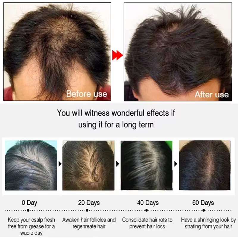 빠른 생강 모발 성장 스프레이, 모발 뿌리 강화, 탈모 - Hair Care For Hair Loss 리뷰 및 가격